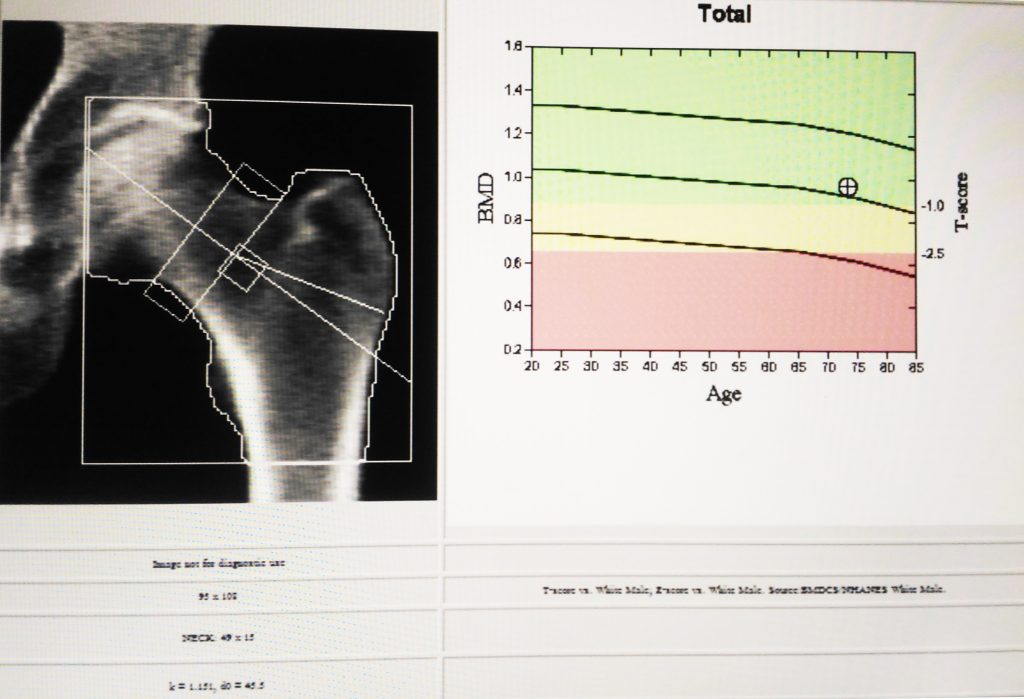 Making Sense of DXA Scans - Hawker Place Physiotherapy and Pilates